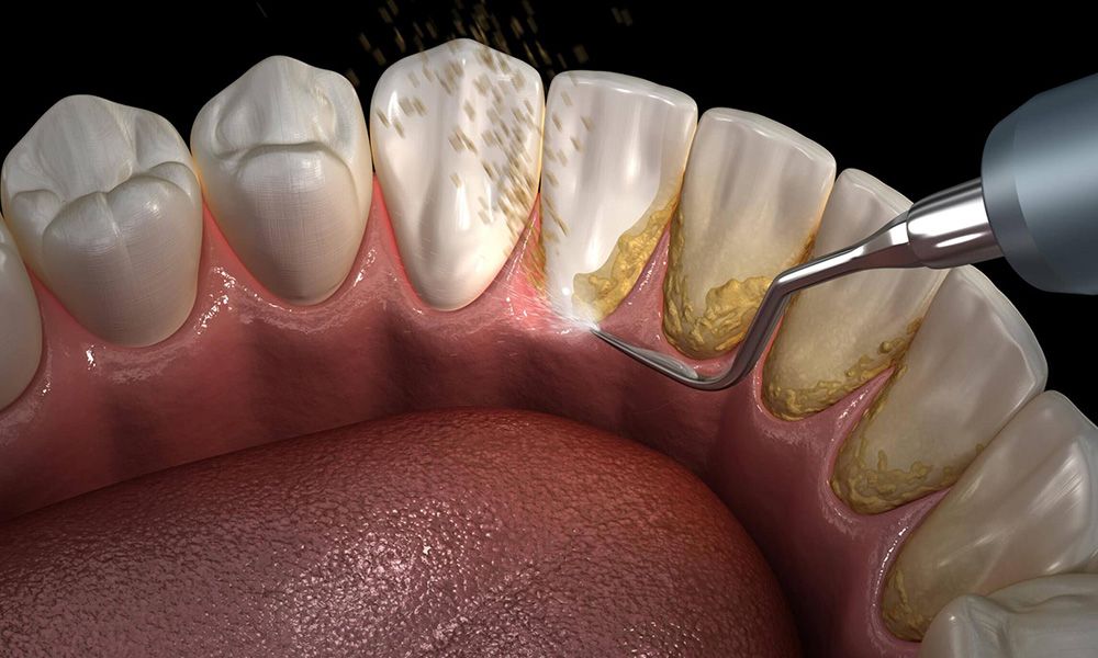 Plaque on teeth