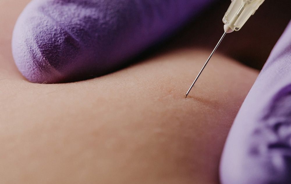Syringe injection needle anesthetic skin