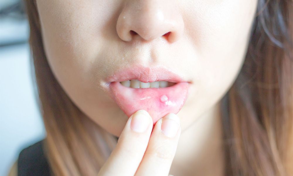 Woman showing mouth ulcer